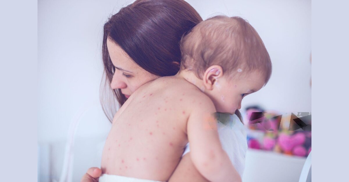 What is Chickenpox?