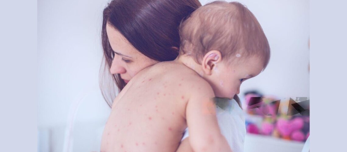 What is Chickenpox?